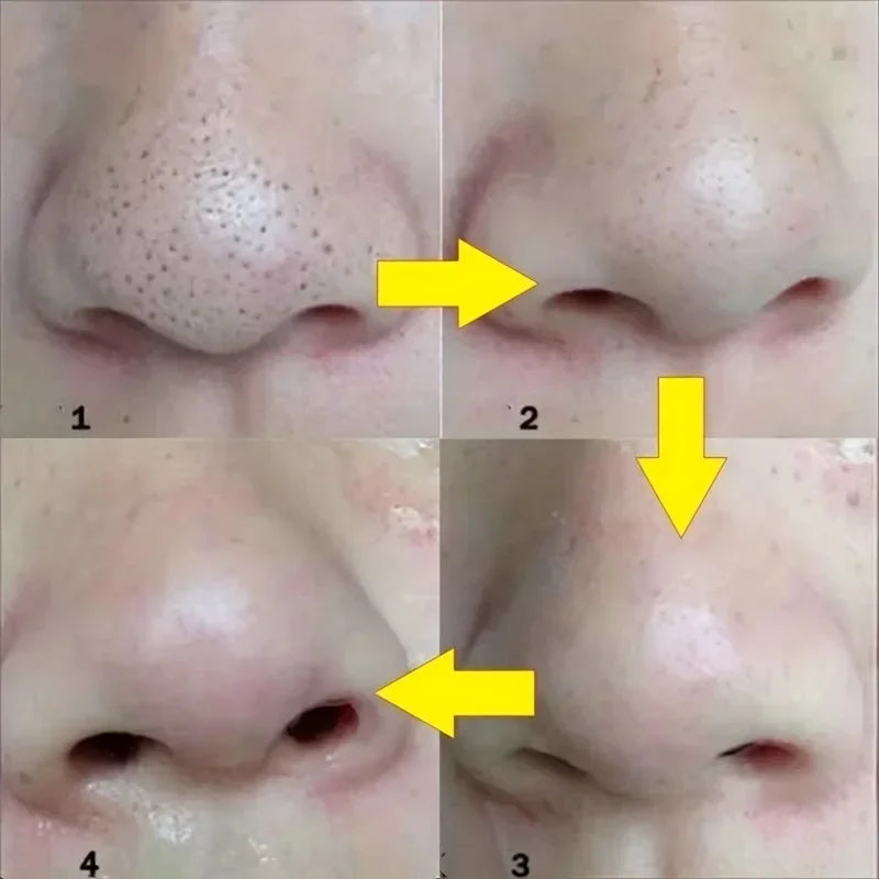 Nose Pore Strips